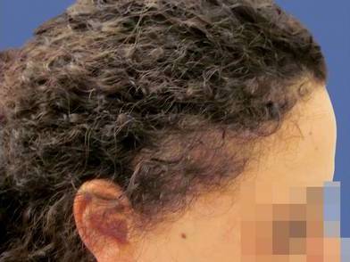 CAS n° 52 - 27 ans - Réparation sur cicatrice greffe de peau - 1201 cheveux