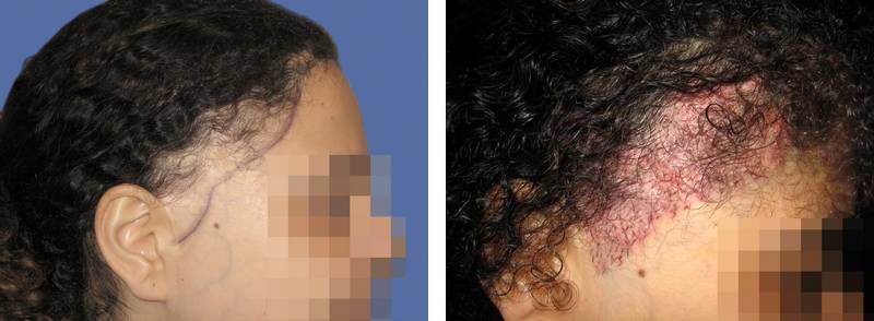 CAS n° 52 - 27 ans - Réparation sur cicatrice greffe de peau - 1201 cheveux