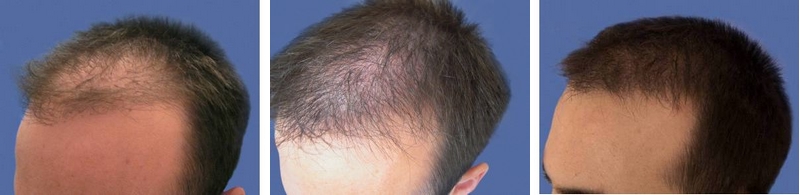 CAS n° 54 - 34 ans - Réparation sur ancienne greffe par bandelette - 2633 cheveux