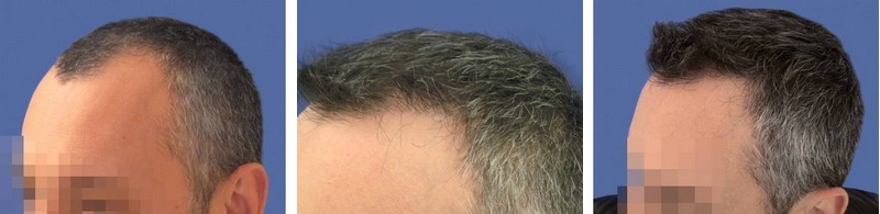 CAS n° 56 - 42 ans - Bordure frontale et golfes - 1766 cheveux