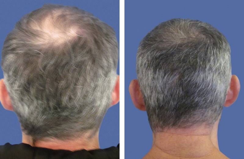 CAS n° 68 - 46 ans - Zone frontale et vertex - 2758 cheveux