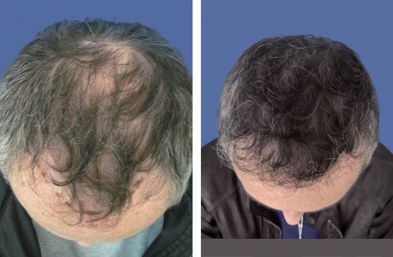 CAS n° 68 - 46 ans - Zone frontale et vertex - 2758 cheveux