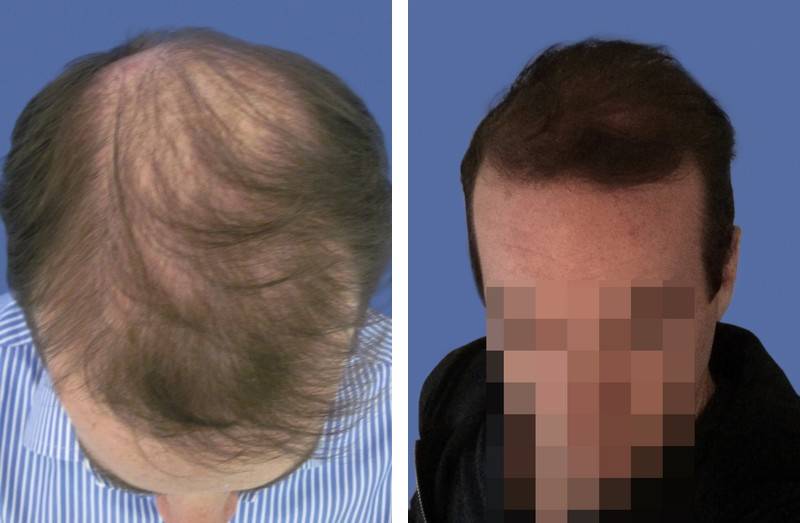 CAS n° 69 - 39 ans - Vertex amélioration de la densité - 2402 cheveux