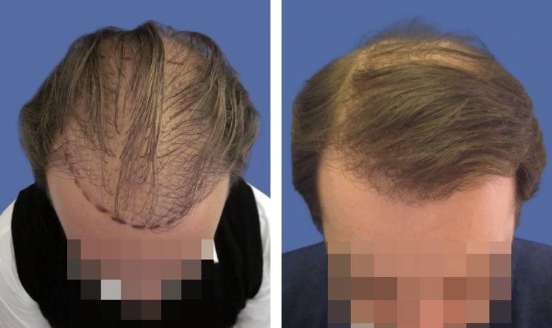 CAS n° 70 - 40 ans - Réparation sur ancienne greffe par bandelette - 4289 cheveux