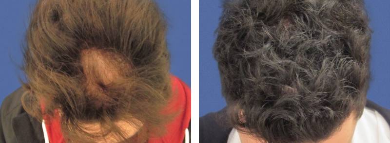 CAS n° 71 - 30 ans - Zone en retrait de la ligne frontale - 2151 cheveux