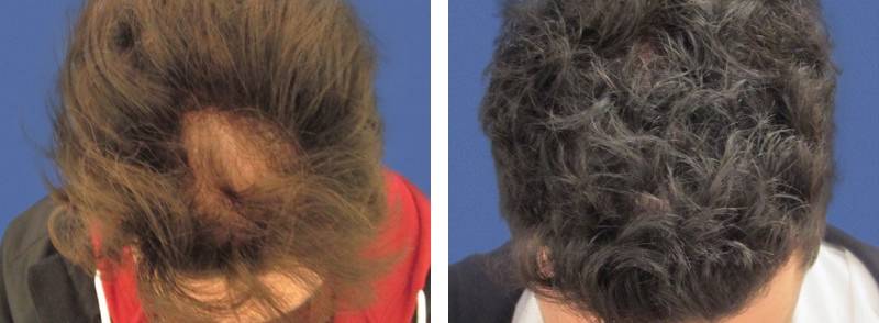 CAS n° 71 - 30 ans - Zone en retrait de la ligne frontale - 2151 cheveux