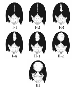 classification de Ludwig pour la calvitie chez la femme