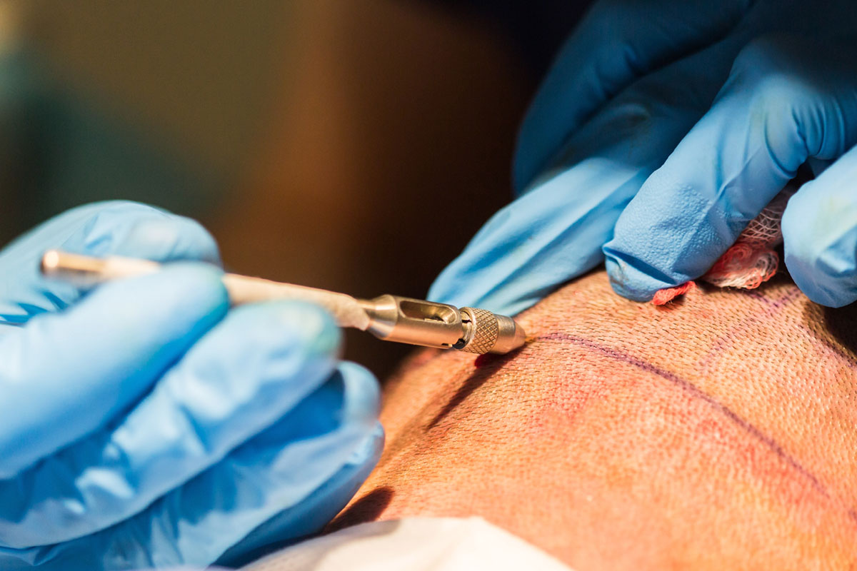 Extraction d'un follicule qui deviendra implant capillaire pour être greffé sur le devant du crâne