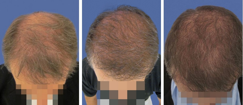 Photo avant / après d'implant capillaire pour améliorer la densité d'une chevelure - 3424 cheveux greffés