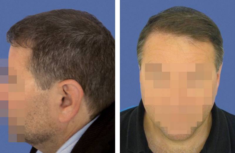 Photo avant / après d'implant capillaire pour améliorer la densité d'une chevelure - 3424 cheveux greffés
