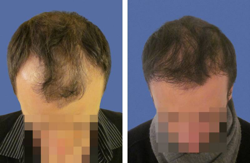 Photo d'implant capillaire avant / après sur zone frontale et 1625 cheveux greffés