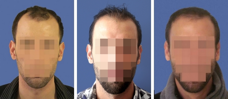 Photo d'implant capillaire avant / après sur zone frontale et 1625 cheveux greffés
