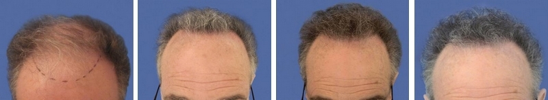 CAS n° 43 - 60 ans - Zone frontale et vertex - 3804 cheveux CAS n° 43 - 60 ans - Zone frontale et vertex - 3804 cheveux