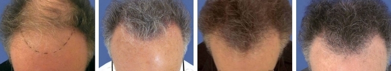 CAS n° 43 - 60 ans - Zone frontale et vertex - 3804 cheveux CAS n° 43 - 60 ans - Zone frontale et vertex - 3804 cheveux