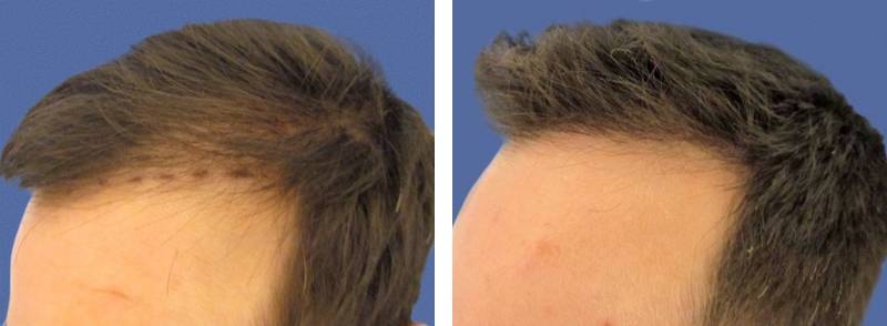 CAS n° 45 - 36 ans - Petits golfes frontaux et tonsure - 2312 cheveux CAS n° 45 - 36 ans - Petits golfes frontaux et tonsure - 2312 cheveux