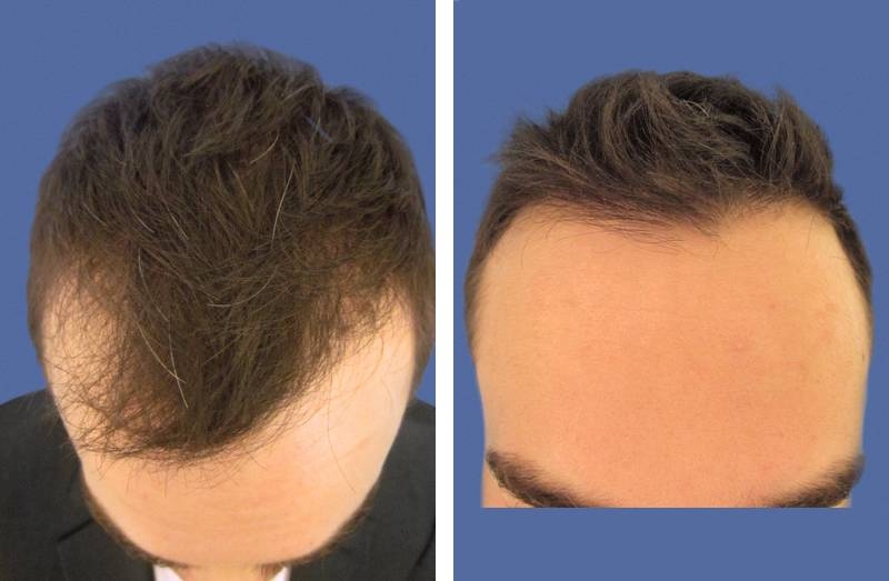 CAS n° 45 - 36 ans - Petits golfes frontaux et tonsure - 2312 cheveux CAS n° 45 - 36 ans - Petits golfes frontaux et tonsure - 2312 cheveux