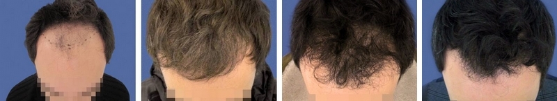 CAS n° 48 - 36 ans - Zone frontale - 2042 cheveux CAS n° 48 - 36 ans - Zone frontale - 2042 cheveux