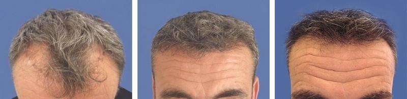 CAS n° 66 - 50 ans - Zone frontale et golfes - 2490 cheveux CAS n° 66 - 50 ans - Zone frontale et golfes - 2490 cheveux