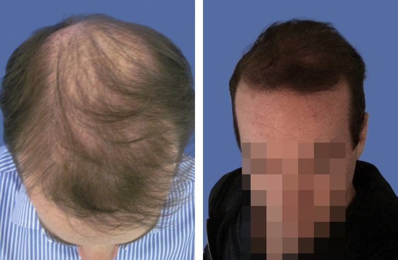 CAS n° 69 - 39 ans - Vertex amélioration de la densité - 2402 cheveux CAS n° 69 - 39 ans - Vertex amélioration de la densité - 2402 cheveux