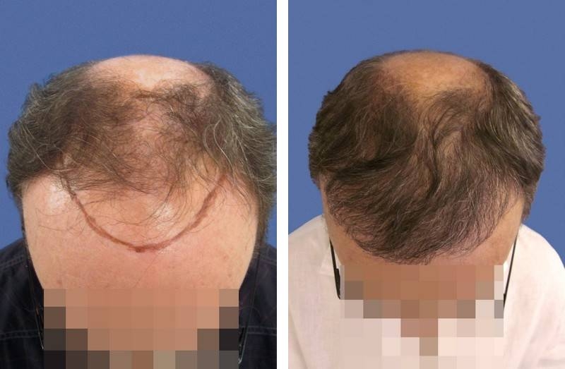 CAS n° 72 - 59 ans - Zone frontale - 2107 cheveux CAS n° 72 - 59 ans - Zone frontale - 2107 cheveux
