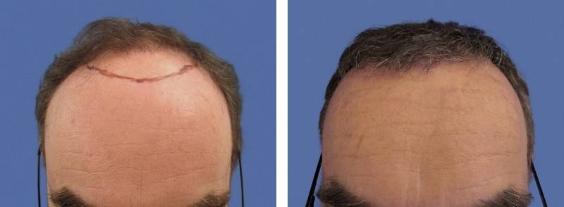 CAS n° 72 - 59 ans - Zone frontale - 2107 cheveux CAS n° 72 - 59 ans - Zone frontale - 2107 cheveux