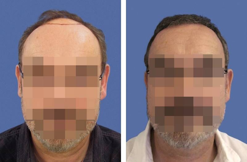 CAS n° 72 - 59 ans - Zone frontale - 2107 cheveux CAS n° 72 - 59 ans - Zone frontale - 2107 cheveux