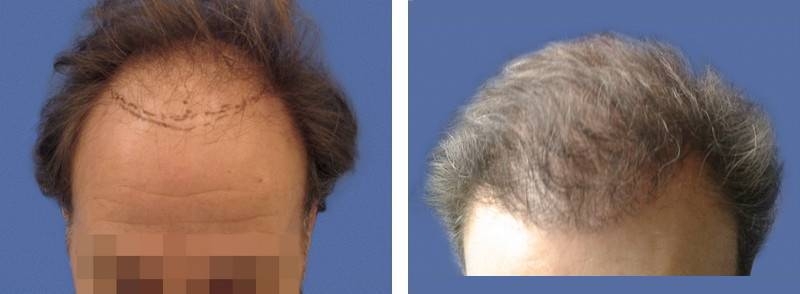 CAS n° 74 - 54 ans - Zone frontale - 2389 cheveux CAS n° 74 - 54 ans - Zone frontale - 2389 cheveux