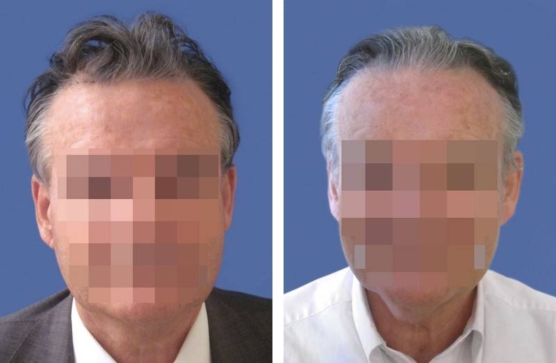 CAS n° 75 - 64 ans - Golfes et zone frontale - 2459 cheveux CAS n° 75 - 64 ans - Golfes et zone frontale - 2459 cheveux