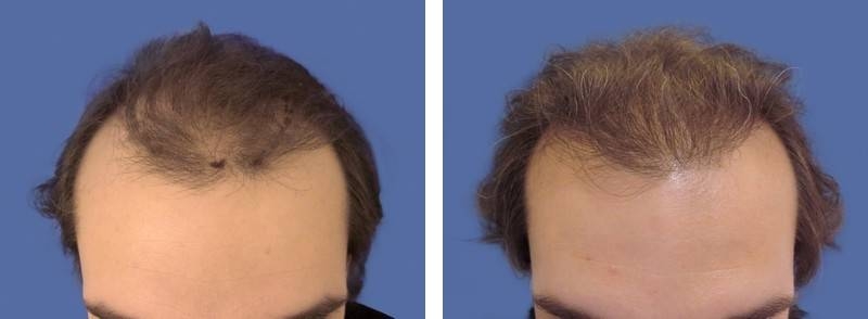 CAS n° 76 - 30 ans - Zone frontale - 2821 cheveux CAS n° 76 - 30 ans - Zone frontale - 2821 cheveux