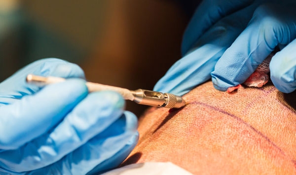 Extraction des follicules pour greffe de cheveux FUE Extraction des follicules pour greffe de cheveux FUE