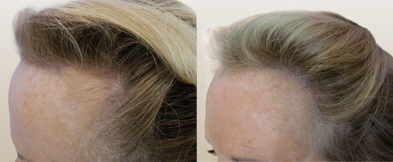 Greffe de cheveux sans cicatrice Greffe de cheveux sans cicatrice