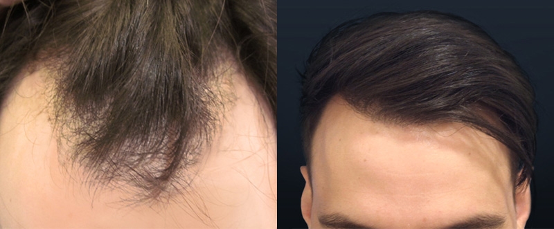 Greffe de cheveux sans cicatrice Greffe de cheveux sans cicatrice