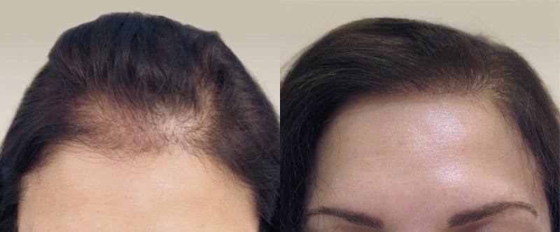 Greffe de cheveux sans cicatrice Greffe de cheveux sans cicatrice