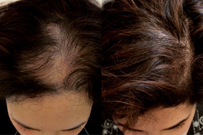 Greffe de cheveux sans cicatrice Greffe de cheveux sans cicatrice