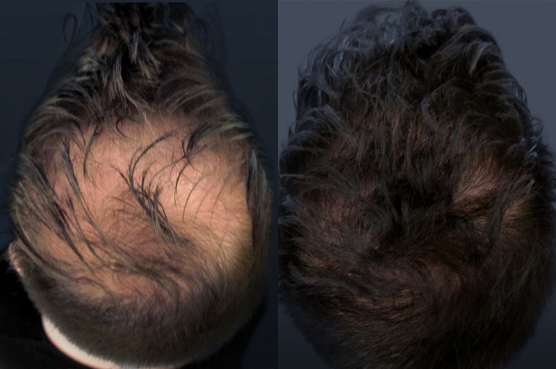 Greffe de cheveux sans cicatrice Greffe de cheveux sans cicatrice