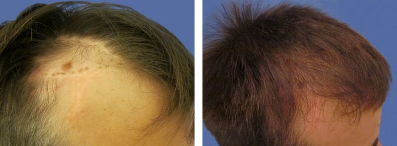 Implant capillaire pour réparer une cicatrice temporale - 972 cheveux greffés Implant capillaire pour réparer une cicatrice temporale - 972 cheveux greffés
