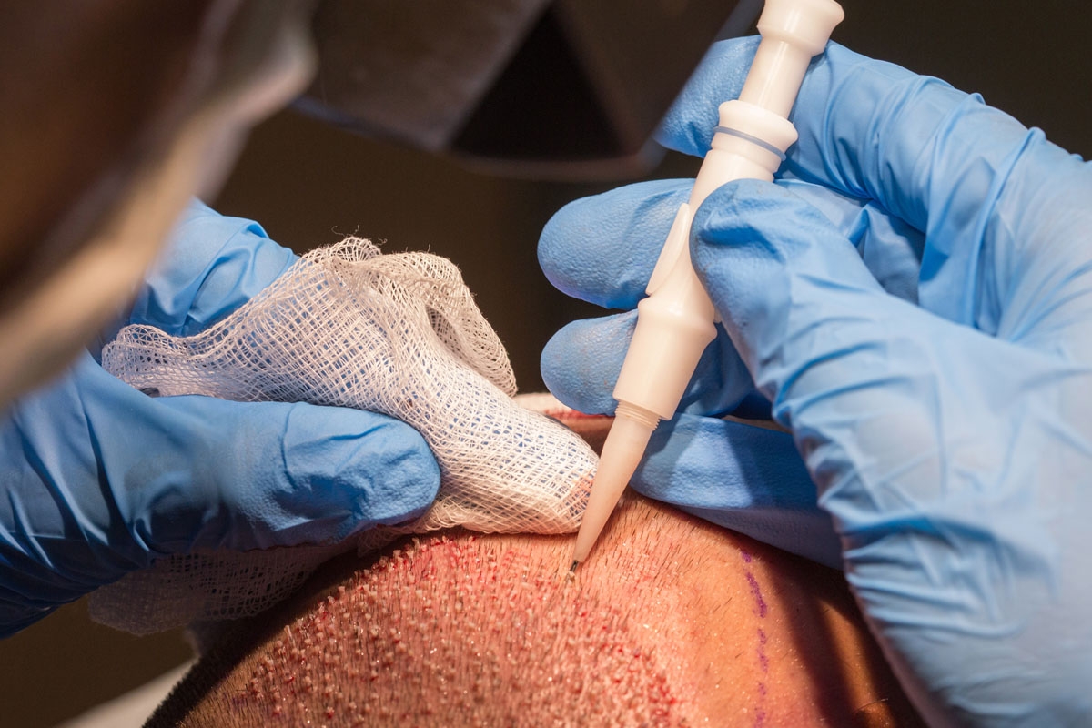 Injection d'un implant capillaire dans la technique de greffe FUE Ultra fine Injection d'un implant capillaire dans la technique de greffe FUE Ultra fine