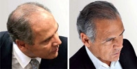 Le Docteur Sydney Ohana avant et après greffe de cheveux Le Docteur Sydney Ohana avant et après greffe de cheveux