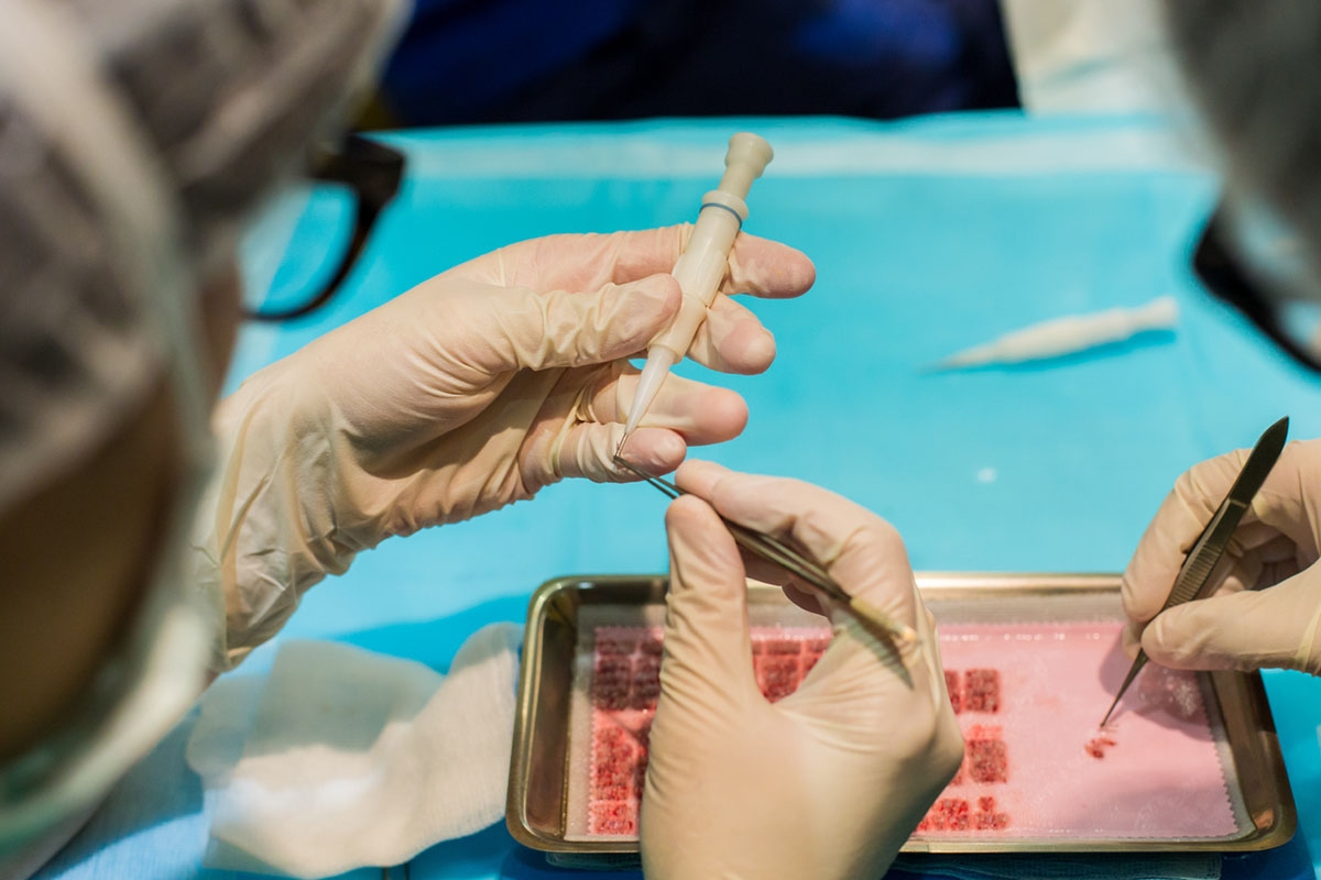 Mise en place des greffons pour leur injection à l'aide de l'injecteur de Choï Mise en place des greffons pour leur injection à l'aide de l'injecteur de Choï
