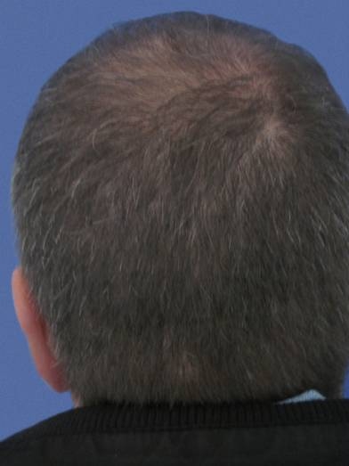 Photo avant / après d'implant capillaire pour améliorer la densité d'une chevelure - 3424 cheveux greffés Photo avant / après d'implant capillaire pour améliorer la densité d'une chevelure - 3424 cheveux greffés
