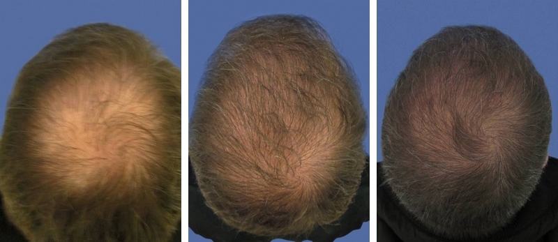Photo avant / après d'implant capillaire pour améliorer la densité d'une chevelure - 3424 cheveux greffés Photo avant / après d'implant capillaire pour améliorer la densité d'une chevelure - 3424 cheveux greffés