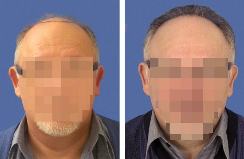 Restauration d"une zone frontale par implant capillaire avec 2688 cheveux greffés Restauration d"une zone frontale par implant capillaire avec 2688 cheveux greffés