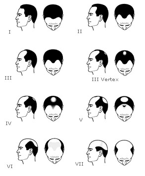 Schéma de la classification de Norwood-Hamilton pour les différents stades de la calvitie masculine Schéma de la classification de Norwood-Hamilton pour les différents stades de la calvitie masculine