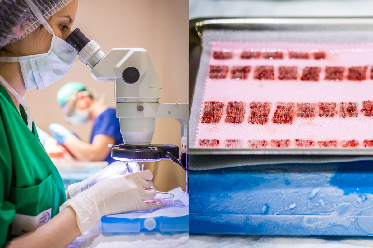 Tri des follicules après extraction avant leur implantation sur la zone dégarnié Tri des follicules après extraction avant leur implantation sur la zone dégarnié