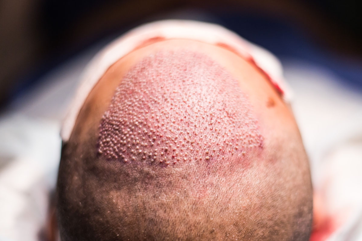 Vue de l'avant du crâne juste après la greffe de cheveux FUE Vue de l'avant du crâne juste après la greffe de cheveux FUE
