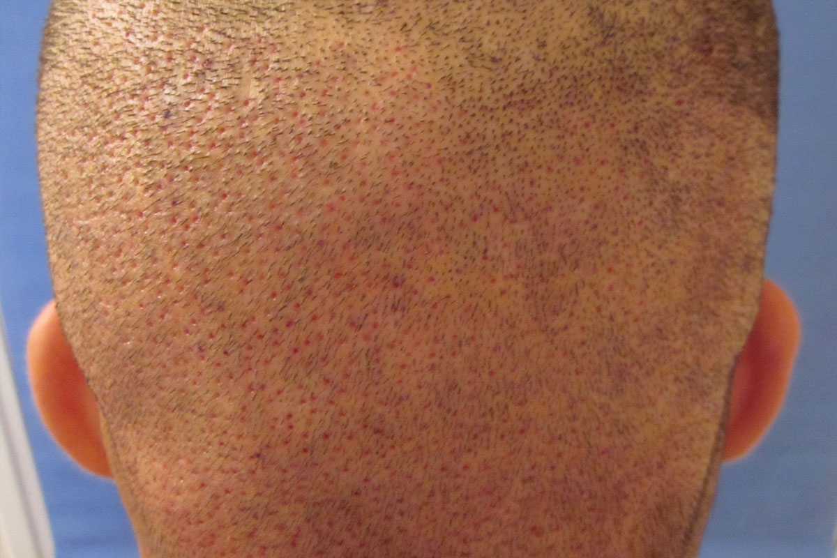 Zone donneuse de l'arrière du crâne après extraction des follicules en vue d'une greffe FUE Zone donneuse de l'arrière du crâne après extraction des follicules en vue d'une greffe FUE