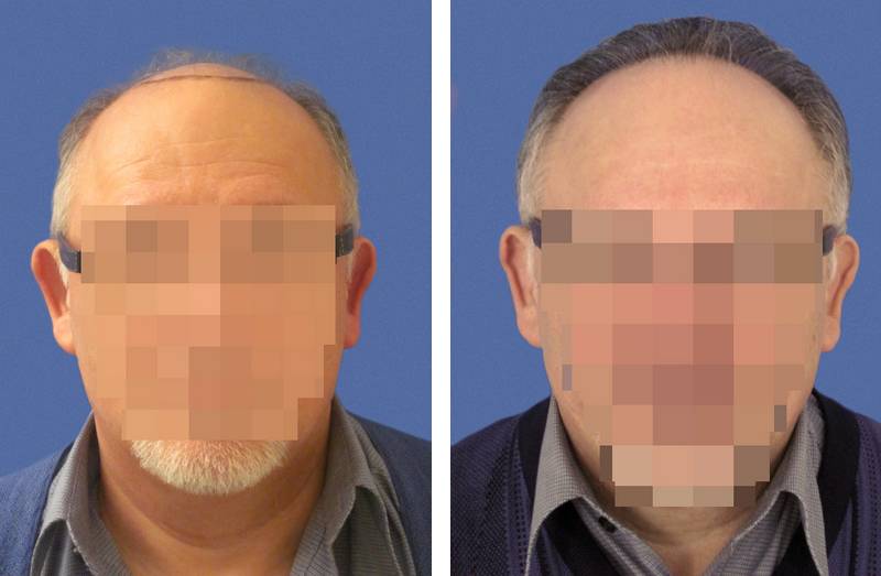 Restauration d"une zone frontale par implant capillaire avec 2688 cheveux greffés