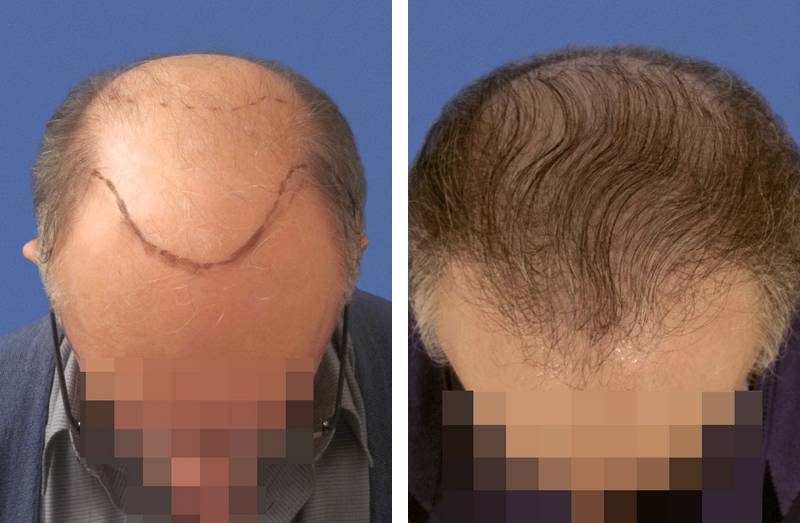 Restauration d"une zone frontale par implant capillaire avec 2688 cheveux greffés