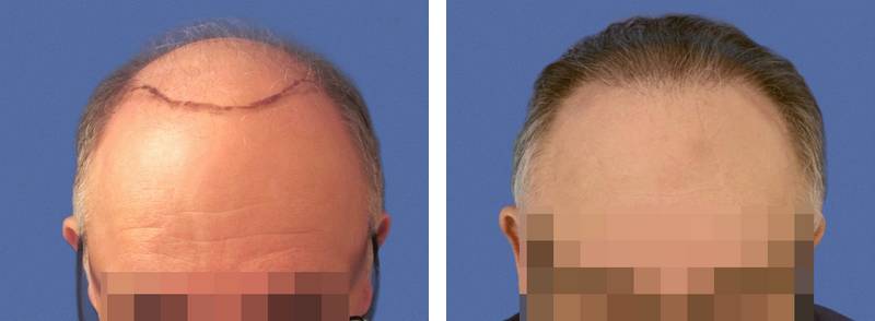 Restauration d"une zone frontale par implant capillaire avec 2688 cheveux greffés