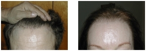 Zone frontale d'une femme: 8 mois après la procédure.